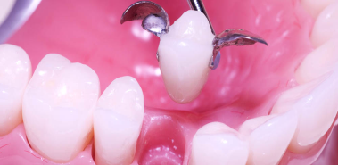 Dental bridges - Costa Rica