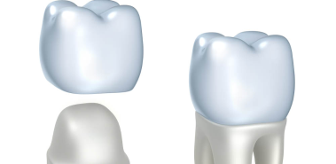 Dental Crowns - Costa Rica